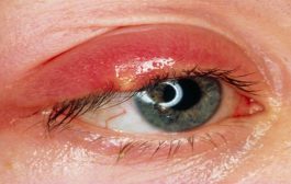 كيف يمكن الوقاية من شحاذ العين؟
