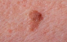 ما هي أبرز الأعراض التي تشير إلى سرطان الجلد؟