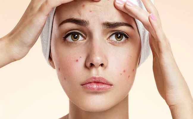 ظهور الحبوب قبل الدورة حالة شائعة…فهل يمكن الوقاية منها؟…