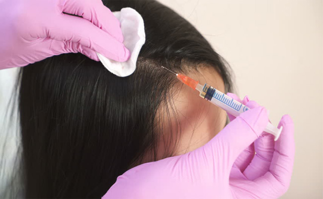 حقائق عن حقن البلازما لفروة الرأس نكشفها لكم
