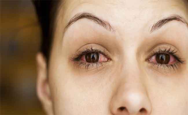 ما الذي يسبّب رمد العين؟ وكيف يُعالج؟