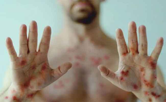 أهم 5 نصائح وإجراءات وقائية للحماية من جدري القردة…