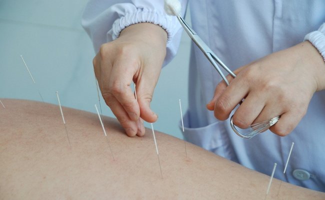 باحثون صينيون يؤكدون أن علاج الوخز بالإبر يساعد كبار السن في الإبقاء على ذاكرة أفضل