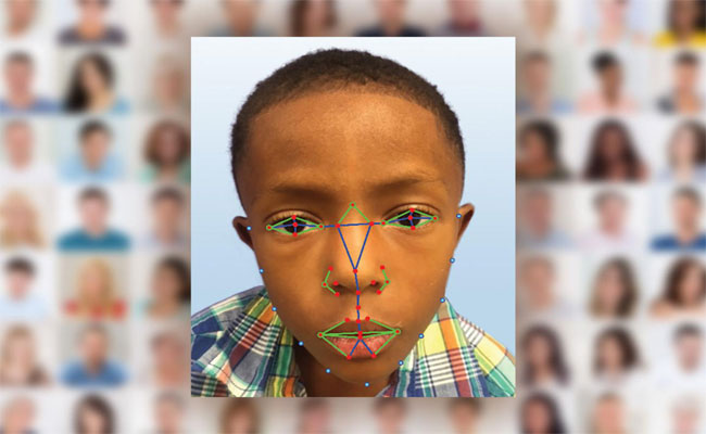 الأطباء يلجؤون لتقنية التعرف على الوجه لتشخيص مرض وراثي نادر