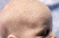 إقتراحات طبّية لمعالجة قشرة الشعر عند الرضّع