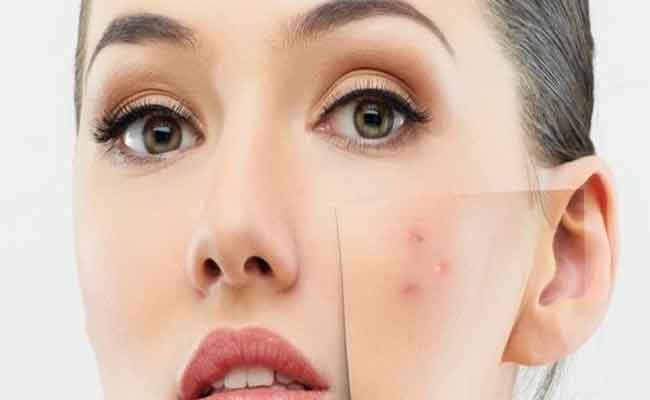 أفضل 3 علاجات للتخلص من البثور الحمراء في الوجه!