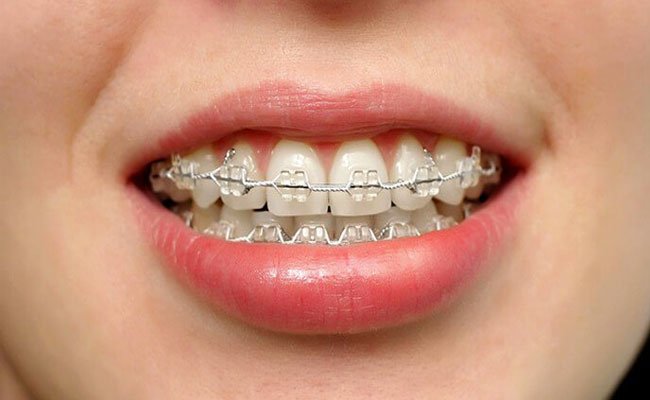 هل تعرفين أنّ هناك 4 أنواع من تقويم الاسنان؟