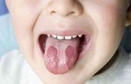 اعراض تشير الى وجود فطريات في فم طفلك