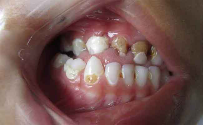 كيف تعالجين البقع التي تظهر على اسنان اطفالك؟