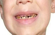 ما هي الاسباب المؤدية الى تآكل الاسنان عند الاطفال؟
