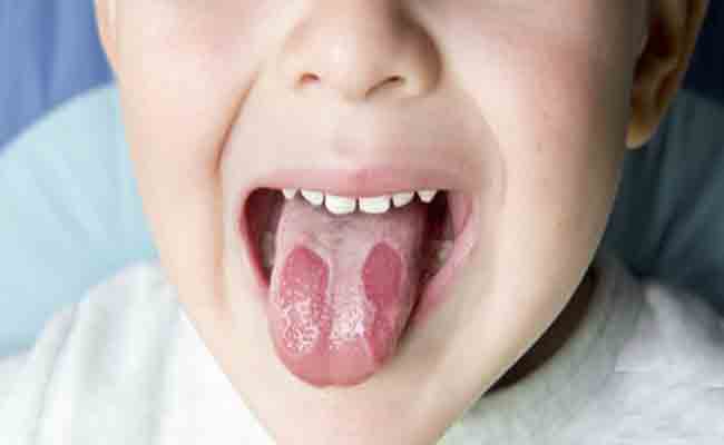 اعراض تشير الى وجود فطريات في فم طفلك