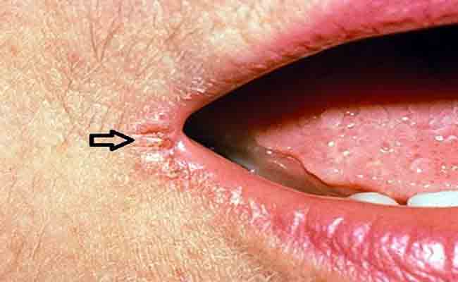 ما هي طرق علاج جفاف الفم؟