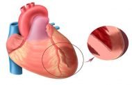 أسباب وأعراض وعلاج احتشاء عضلة القلب