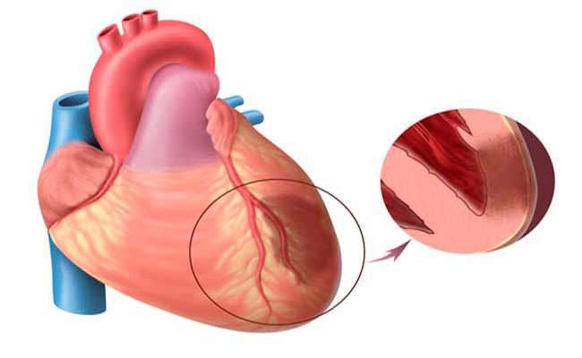 أسباب وأعراض وعلاج احتشاء عضلة القلب