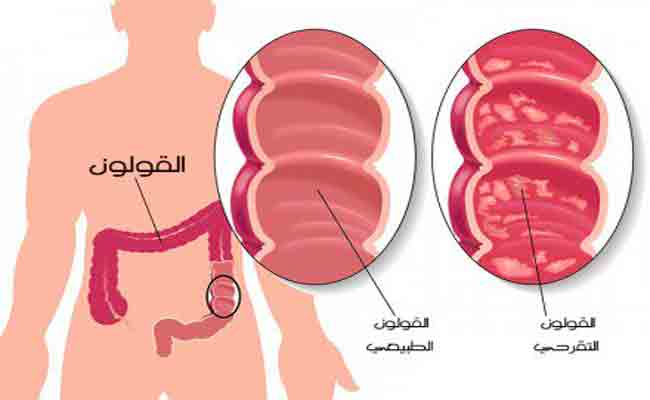 ما هي اسباب حدوث التهاب في المستقيم؟