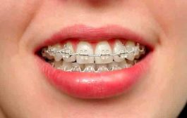 هل تعرفين أنّ هناك 4 أنواع من تقويم الاسنان؟