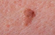 ما هي أبرز الأعراض التي تشير إلى سرطان الجلد؟