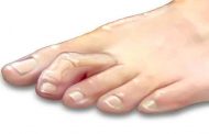 ما هي تشوّهات أصابع القدم الأكثر شيوعاً؟