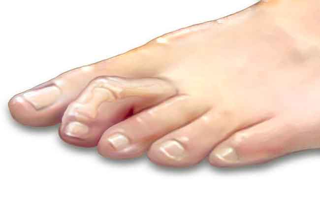 ما هي تشوّهات أصابع القدم الأكثر شيوعاً؟