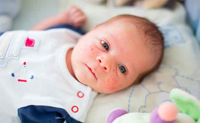 لماذا يٌصاب طفلك بالاكزيما؟