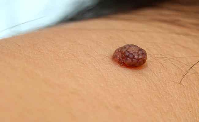 كيفية إزالة الأورام الجلدية الحميدة