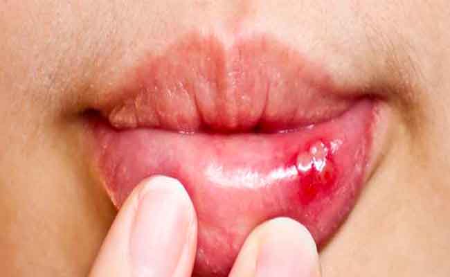 هل تُسبّب فطريات الفم ألماً عند الإصابة بها...؟