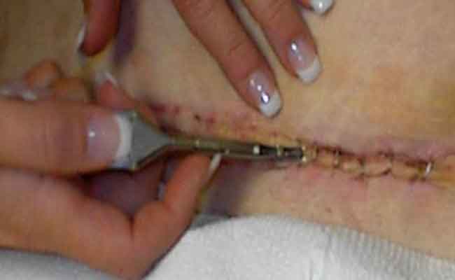 التهاب جرح الولادة القيصرية…