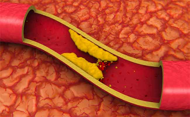 هل من رابط بين الكولسترول والأزمة القلبية؟