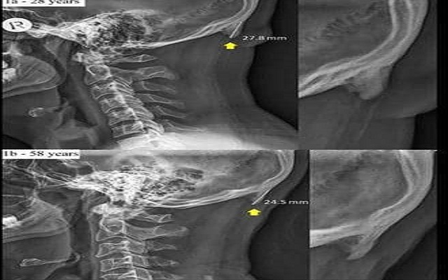 الهواتف تسبب مشكل “شوكة الجمجمة”…