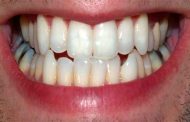 اختلاف نوعية الأسنان...