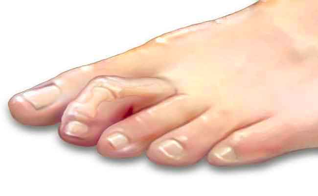 ما هي تشوّهات أصابع القدم الأكثر شيوعاً...؟
