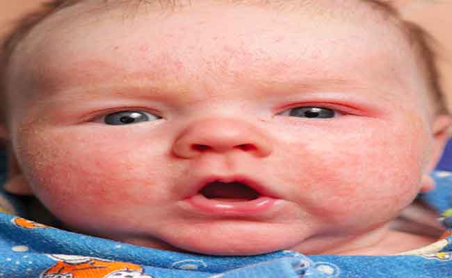 هذه الأسباب قد تؤدي إلى احمرار جلد الرضيع...!