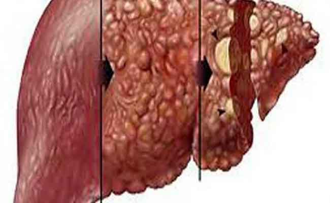 ماذا يحصل في المرحلة الرابعة من سرطان الكبد...؟
