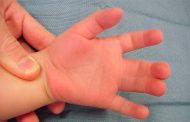 لماذا قد يولد الطفل بأصابع ملتصقة؟ وما هو الحل...؟