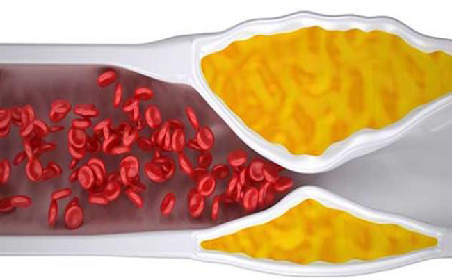 كيف يمكن إزالة دهون الشرايين…؟
