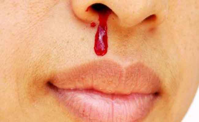 كيف تتصرفون عندما تعانون من نزيفٍ في الأنف…؟