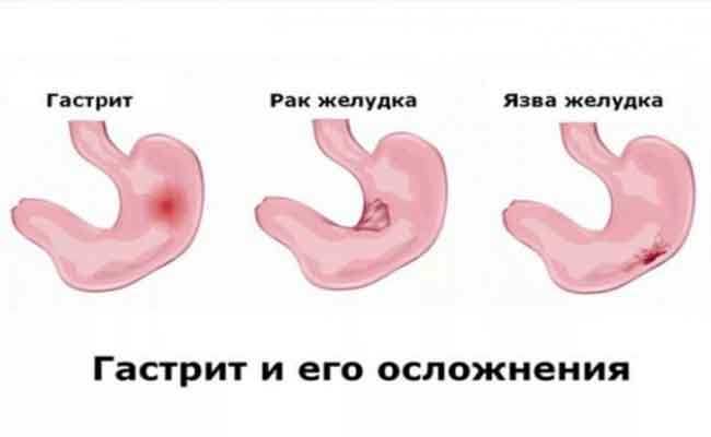 عالجوا الإرتجاع المريئي من خلال التغذية الصحيحة…!