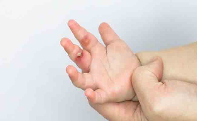 إرشادات مهمة لحماية طفلكم من الحروق…!