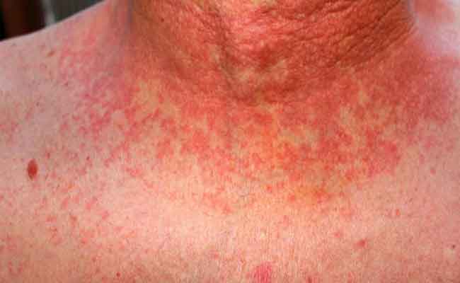 ولاية سعيدة تسجل 64 حالة مؤكد إصابتها بالحمى المالطية