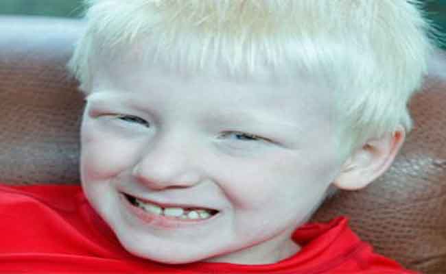 المهق…هل هو مرض وراثي؟…وما هي أعراضه…؟