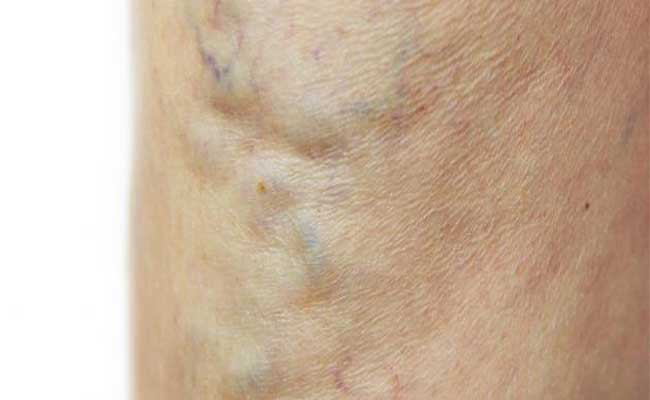 كيف يمكن ان تعالجي الدوالي بشكلٍ آمن خلال الحمل…؟