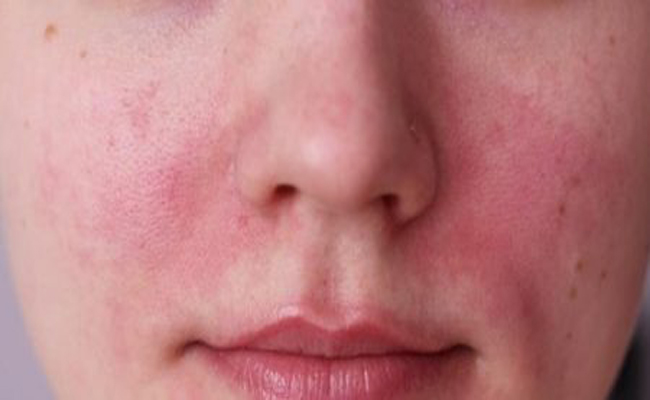 هل يمكن أن تكون البشرة الدهنية حسّاسة؟…