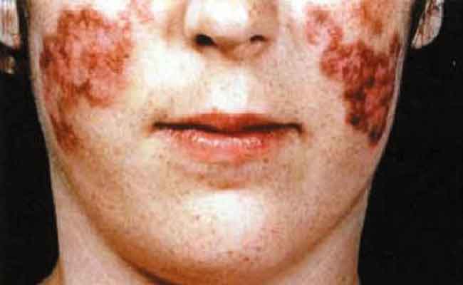 في أي حالات يمكن ان يؤدي مرض الذئبة الحمراء للوفاة…؟