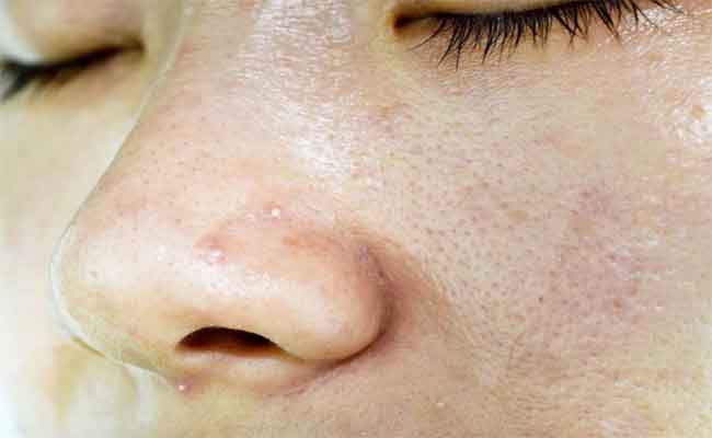 4 علاجات منزلية للحفاظ على نضارة البشرة الدهنية…