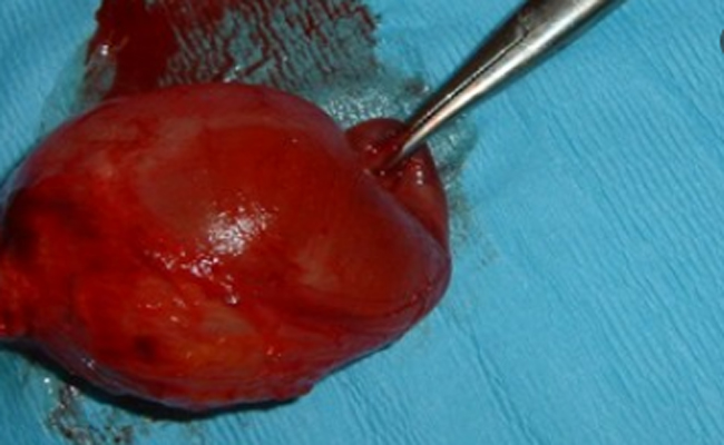 كيسة بارثولين المهبلية هل هي خطيرة؟…