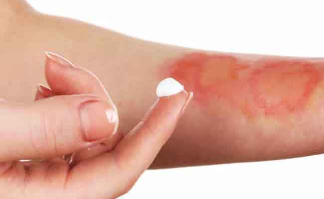 الحروق السطحية يمكن علاجها منزلياً…كيف؟