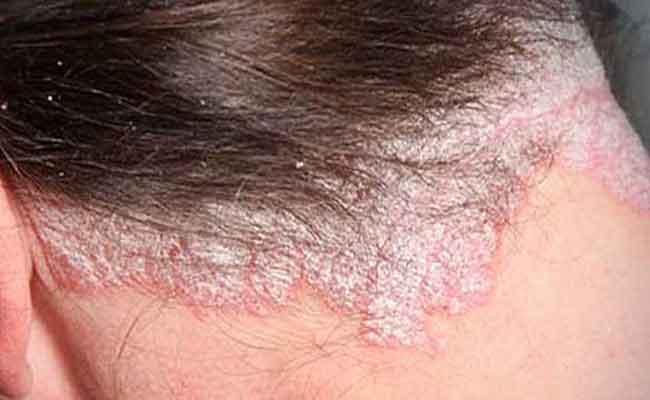 هل يمكن علاج صدفية فروة الرأس في المنزل؟…