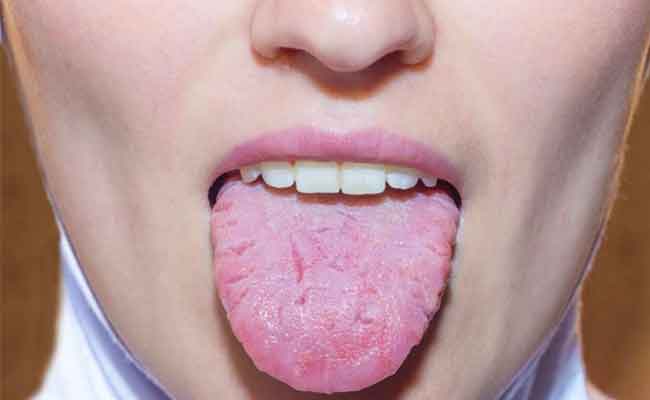 هل التهاب اللسان يشير الى انّكم مصابين بفيروس كورونا؟…