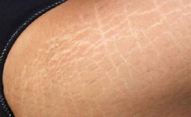 كيف يمكنكِ محاربة السيلوليت خلال الحمل؟…