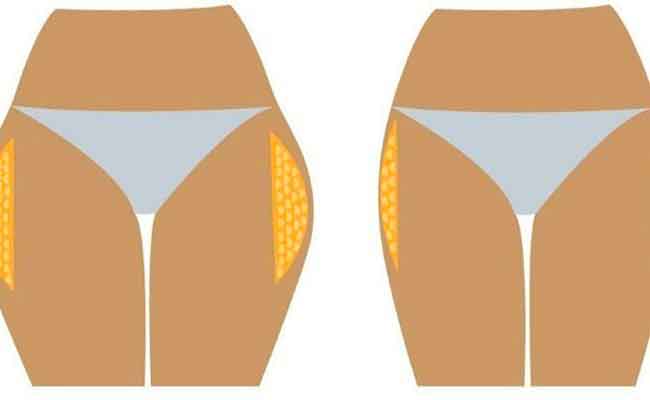 ماذا تعرفون عن عملية تنحيف الأرداف؟…